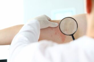 cazuri de lepra in romania cum se manifesta si cum se trateaza boala 6943e24cc69db