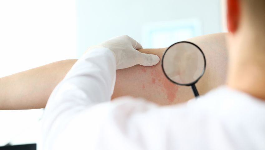 cazuri de lepra in romania cum se manifesta si cum se trateaza boala 6943e24cc69db