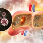 o dieta populara vinovata pentru cancerul hepatic accelereaza aparitia lui prin reprogramarea celulelor hepatice 695f8e3bc3c8e