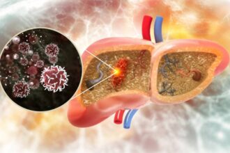 o dieta populara vinovata pentru cancerul hepatic accelereaza aparitia lui prin reprogramarea celulelor hepatice 695f8e3bc3c8e