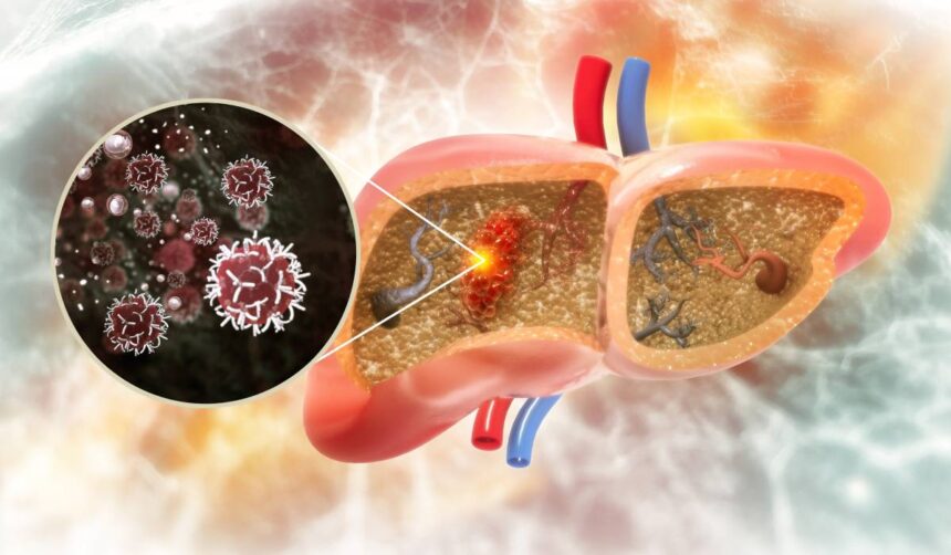 o dieta populara vinovata pentru cancerul hepatic accelereaza aparitia lui prin reprogramarea celulelor hepatice 695f8e3bc3c8e