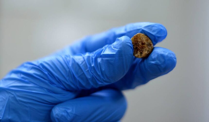 adio pietre la fiere alimentul de origine animala care poate reduce riscul de calculi biliari stimuleaza golirea vezicii biliare 6997f3c4dd271