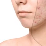 de ce apar petele pigmentare mai repede vara remedii naturale care uniformizeaza tenul 6a033c238d850