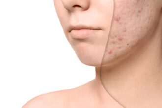 de ce apar petele pigmentare mai repede vara remedii naturale care uniformizeaza tenul 6a033c238d850