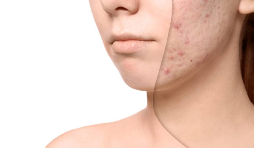 de ce apar petele pigmentare mai repede vara remedii naturale care uniformizeaza tenul 6a033c238d850