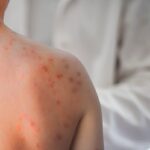 descoperire majora in lupta impotriva rujeolei cercetatorii au gasit anticorpi capabili sa previna si sa trateze infectia 6a0332d51c86d