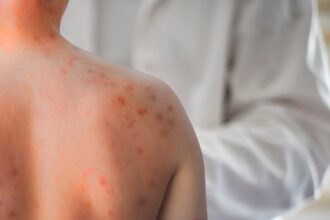 descoperire majora in lupta impotriva rujeolei cercetatorii au gasit anticorpi capabili sa previna si sa trateze infectia 6a0332d51c86d