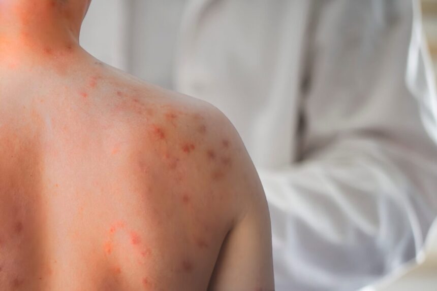 descoperire majora in lupta impotriva rujeolei cercetatorii au gasit anticorpi capabili sa previna si sa trateze infectia 6a0332d51c86d
